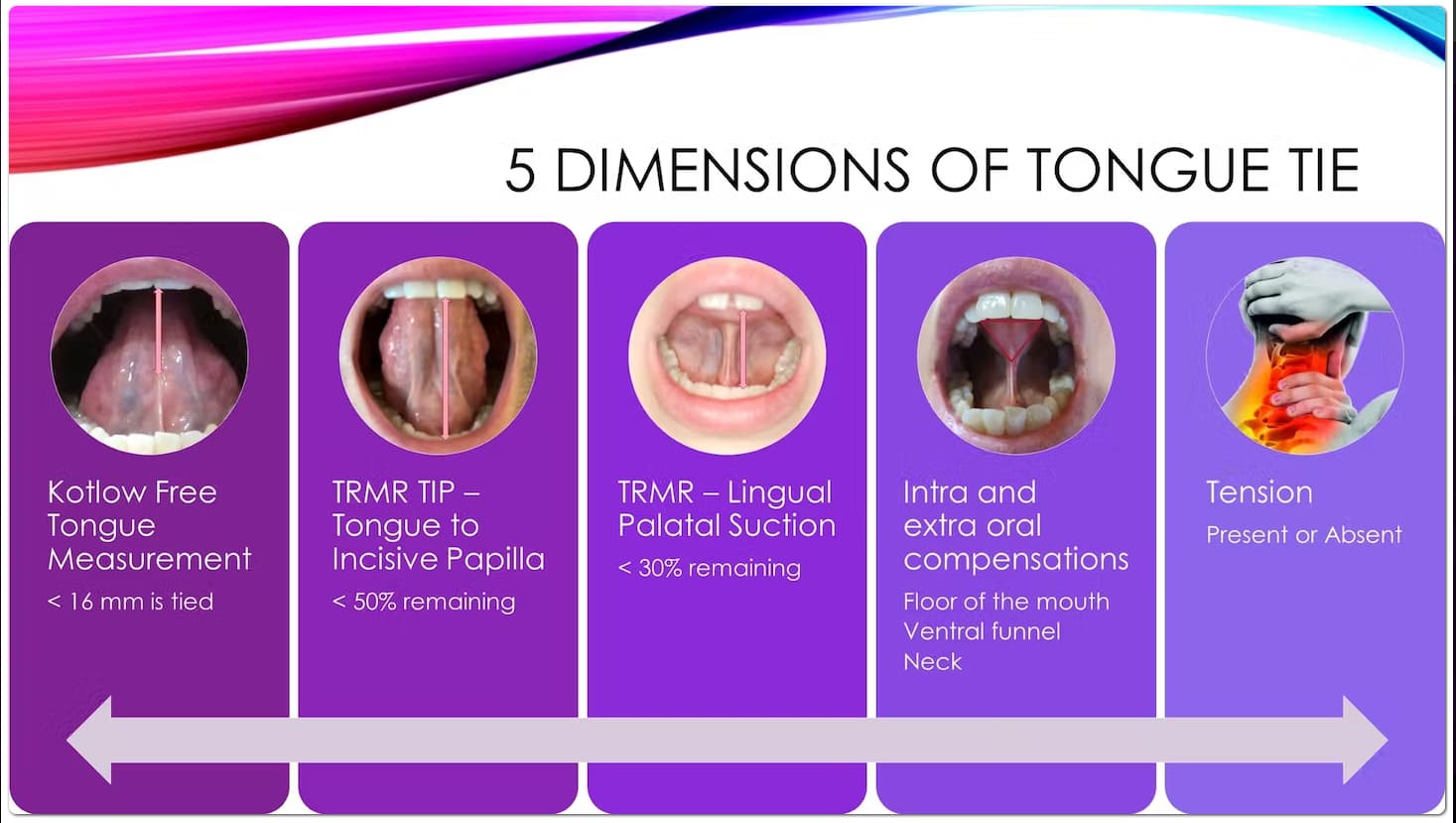 The five dimensions of tongue tie: free tongue measurement, tongue to incisive papilla, lingual palatal suction, oral compensations and tension